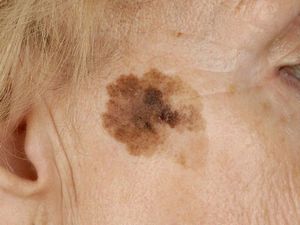 Симптомы и диагностика базально-клеточного рака кожи в Израиле