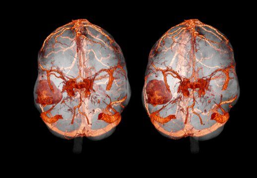 Метастазы в головной мозг