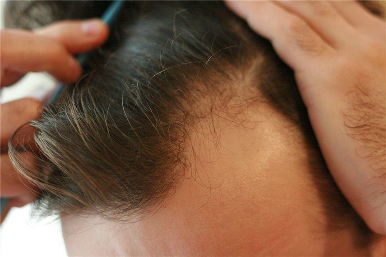 Пересадка волос в Израиле